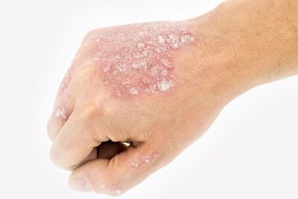 mechanisme voor de ontwikkeling van psoriasis op de handen