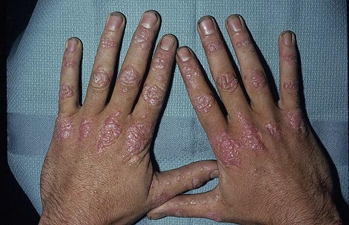 redenen voor de ontwikkeling van psoriasis op de handen