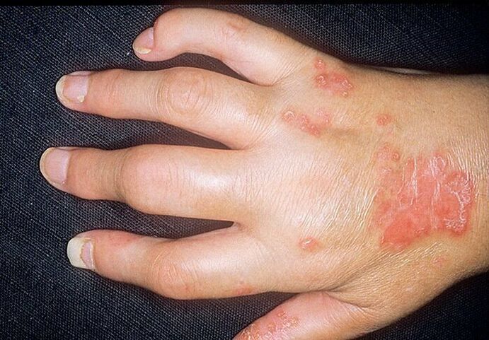 artritis psoriatica op de handen