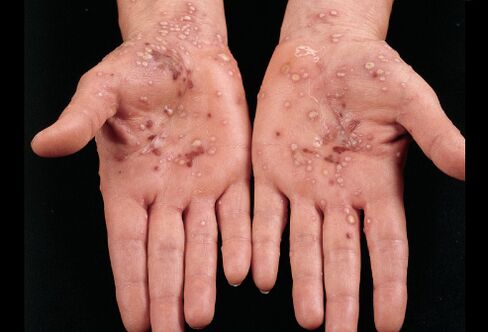 hoe ziet psoriasis eruit op de handpalmen