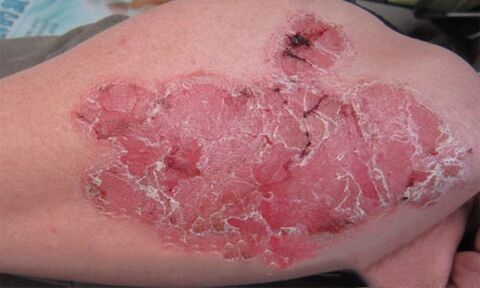 hoe ziet pustuleuze psoriasis eruit op de huid