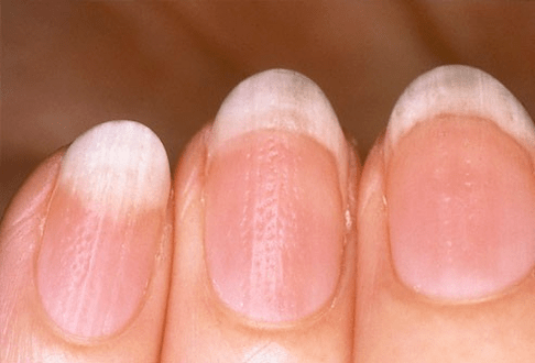psoriasis op de nagels
