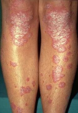 Manifestaties van psoriasis op de benen