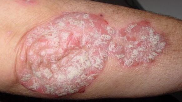 Oude psoriasis