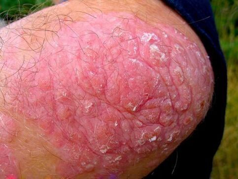 psoriasis vulgaris op de knie
