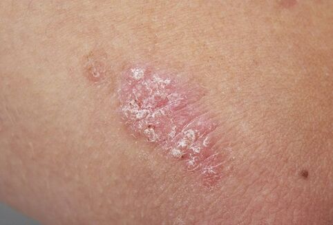 psoriatische plaque op de huid