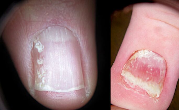 Afbrokkelende nagels met psoriasis
