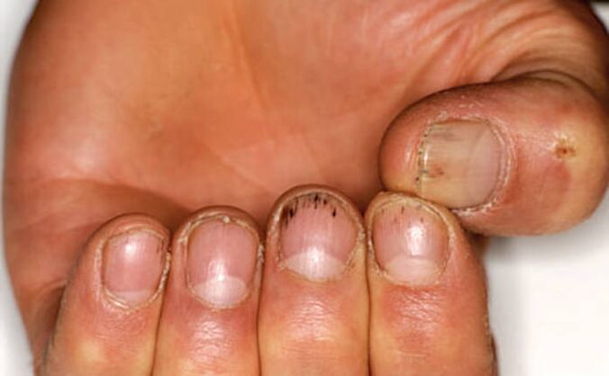 Bloeding onder de nagels met psoriasis