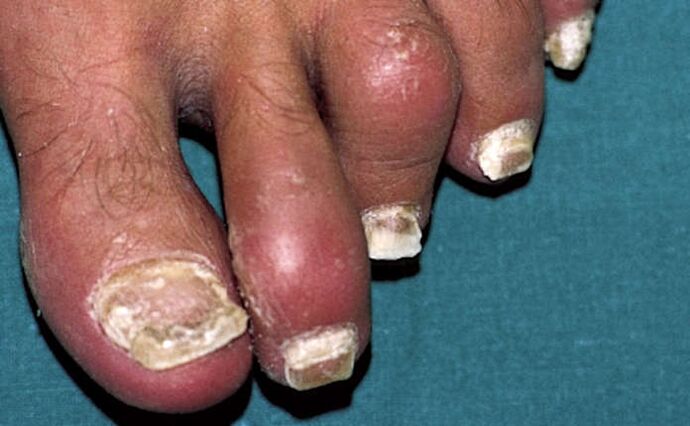Psoriasis met aangetaste nagels en gewrichtsontsteking (artritis) van de tenen