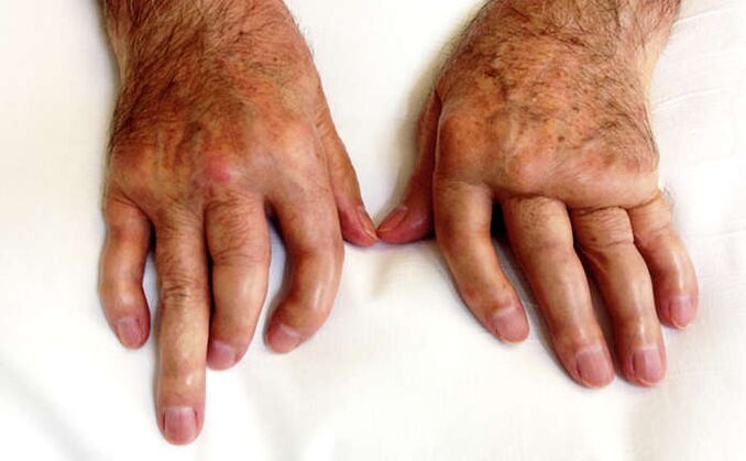 Verminkende artritis bij psoriasis