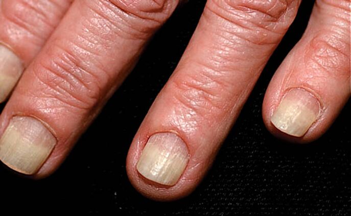 Psoriasis van nagels op handen voeten: oorzaken, diagnose en met een foto | Officiële site Dr. DERM