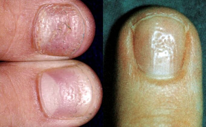 Vingerhoedsymptoom - meerdere depressies op het oppervlak van de nagelplaat