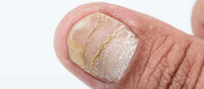 acute vorm van complicaties van psoriasis op de nagel