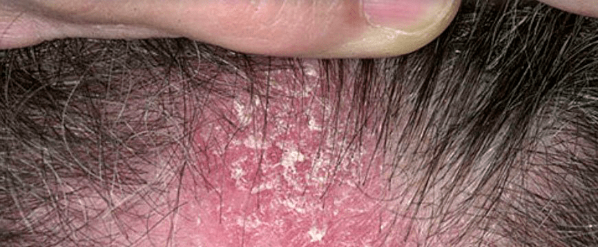 huidlaesies op de hoofdhuid met psoriasis