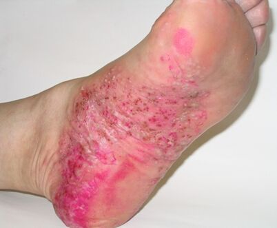 psoriasis op de voet